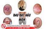 Sưng đau hậu môn biểu hiện của bệnh lý nguy hiểm