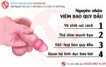 Nguyên nhân, dấu hiệu và cách điều trị viêm bao quy đầu
