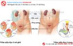 Số người mắc bệnh viêm niệu đạo lên đến 53%