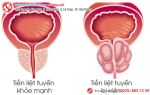 Còn ai khác đang bị viêm tuyến tiền liệt