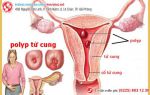 Polyp tử cung là gì? Có nguy hiểm không?