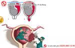 Bác sĩ “nháo nhào” cứu thai phụ vì bị sót nhau thai