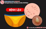 Biểu hiện bệnh lậu – đa số đều không biết đến thông tin này