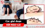 Các giai đoạn sùi mào gà và biểu hiện cụ thể
