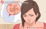 Hình ảnh gai sinh dục ở nữ