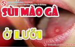 Góc giải đáp | Sùi mào gà ở lưỡi có làm bạn lo lắng?