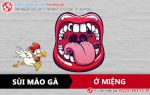 Những thông tin về bệnh sùi mào gà ở miệng