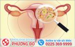 Dấu Hiệu Bị Viêm Vùng Kín Nguyên Nhân Và Cách Điều Trị?