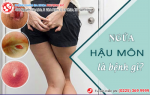 Ngứa hậu môn nguyên nhân chính do bị bệnh trĩ
