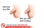 Hẹp bao quy đầu có nên làm phẫu thuật không?