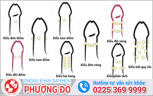 Các kiểu gắn bi cho nam giới