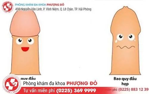 Hẹp. bán hẹp bao quy đầu gây ra nhiều biến chứng nguy hiểm Hẹp. bán hẹp bao quy đầu gây ra nhiều biến chứng nguy hiểm
