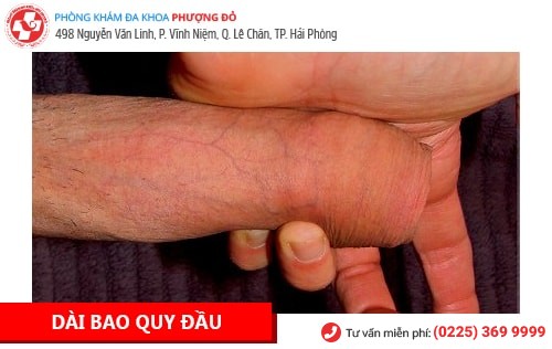 Bệnh Dương Vật Là Gì? Cách Chữa Trị Hiệu Quả Hiện Nay Bệnh Dương Vật Là Gì? Cách Chữa Trị Hiệu Quả Hiện Nay