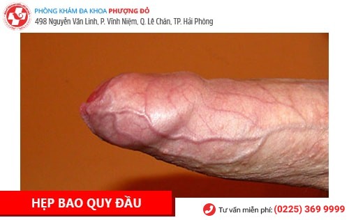 Bệnh Dương Vật Là Gì? Cách Chữa Trị Hiệu Quả Hiện Nay Bệnh Dương Vật Là Gì? Cách Chữa Trị Hiệu Quả Hiện Nay