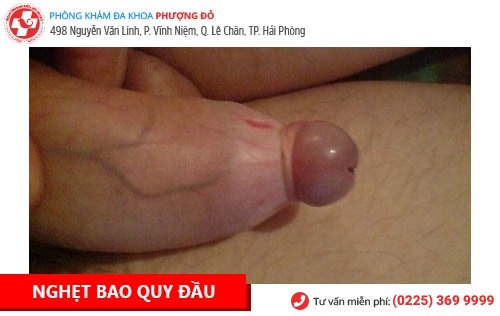 Bệnh Dương Vật Là Gì? Cách Chữa Trị Hiệu Quả Hiện Nay Bệnh Dương Vật Là Gì? Cách Chữa Trị Hiệu Quả Hiện Nay