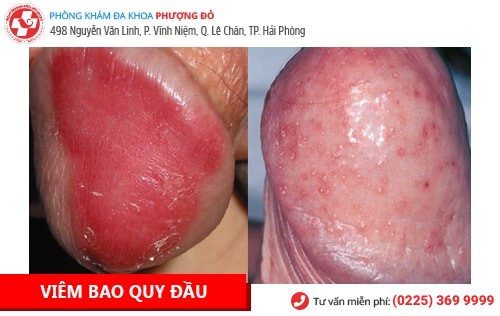 Bệnh dương vật là gì? Cách chữa trị hiệu quả hiện nay Bệnh dương vật là gì? Cách chữa trị hiệu quả hiện nay