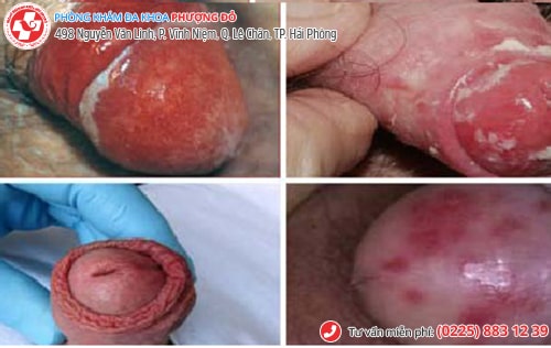 bệnh ở bao quy đầu