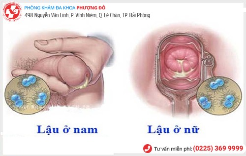 bệnh lậu