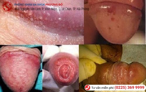 1 số bệnh ở bao quy đầu thường gặp 1 số bệnh ở bao quy đầu thường gặp