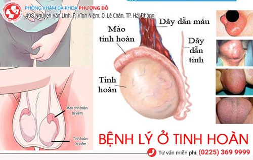 1 số triệu chứng bệnh tinh hoàn cần đi khám ngay 1 số triệu chứng bệnh tinh hoàn cần đi khám ngay