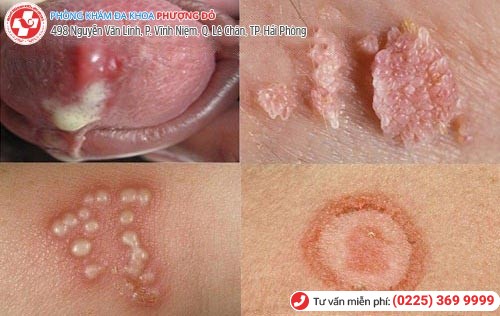 Nhóm bệnh xã hội dễ lây lan và gây nhiều biến chứng nguy hiểm Nhóm bệnh xã hội dễ lây lan và gây nhiều biến chứng nguy hiểm