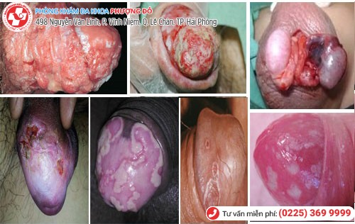 biến chứng nấm dương vật