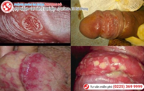 biến chứng nứt bao quy đầu