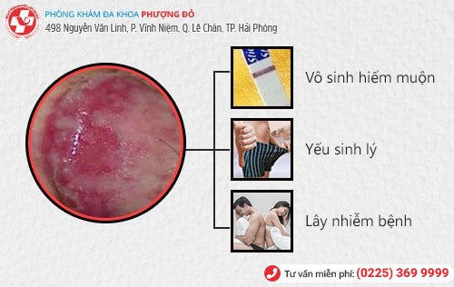 Viêm bao quy đầu là gì? Giải đáp chi tiết từ bác sĩ chuyên khoa Viêm bao quy đầu là gì? Giải đáp chi tiết từ bác sĩ chuyên khoa