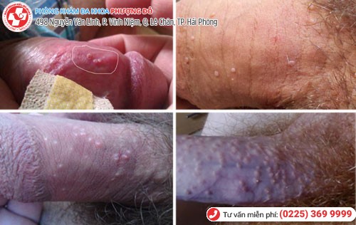 Cận cảnh hình ảnh nổi mụn bao quy đầu Biểu hiện nổi mụn bao quy đầu