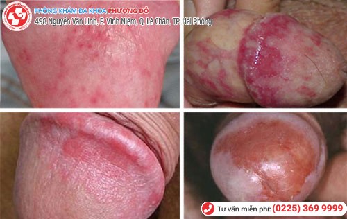 Viêm bao quy đầu ở nam Biểu hiện viêm bao quy đầu