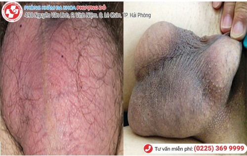 hình ảnh bìu sưng đỏ