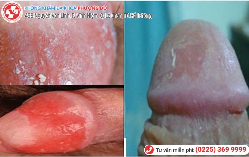 Hình ảnh bợn trắng ở bao quy đầu Hình ảnh bợn trắng ở bao quy đầu