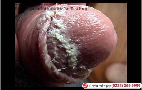 Hình ảnh bợn trắng bao quy đầu Hình ảnh bợn trắng bao quy đầu