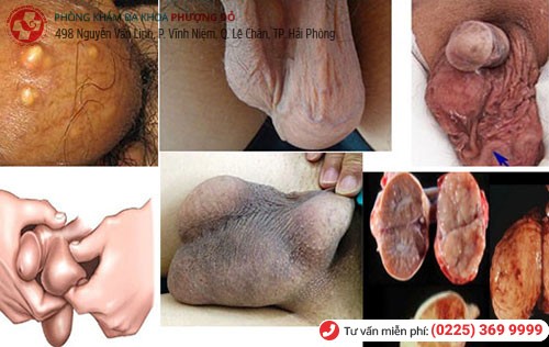 Các trường hợp cần đi khám tinh hoàn sớm Các trường hợp cần đi khám tinh hoàn sớm