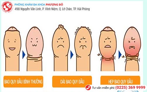 Dài, hẹp, nghẹt bao quy đầu cần lột bao quy đầu sớm Dài, hẹp, nghẹt bao quy đầu cần lột bao quy đầu sớm