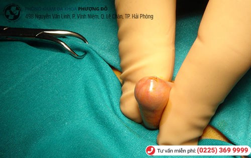 Tiểu phẫu cắt bao quy đầu tại Phòng Khám Phượng Đỏ Tiểu phẫu cắt bao quy đầu tại Phòng Khám Phượng Đỏ