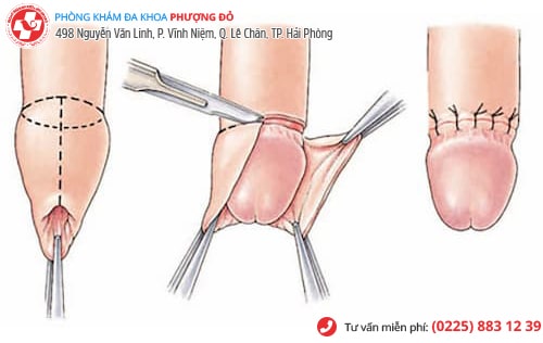 Phương pháp tiểu phẫu cắt bao quy đầu công nghệ xâm lấn tối thiểu Hàn Quốc Phương pháp tiểu phẫu cắt bao quy đầu công nghệ xâm lấn tối thiểu Hàn Quốc