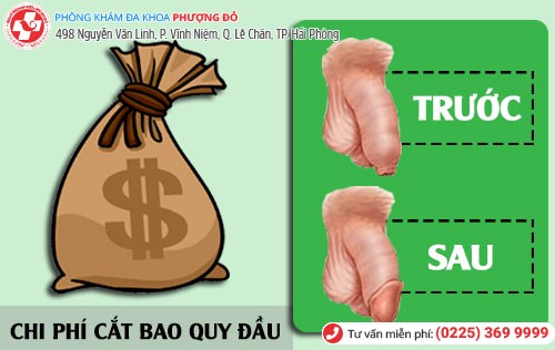 Chi phí cắt bao quy đầu Chi phí cắt bao quy đầu