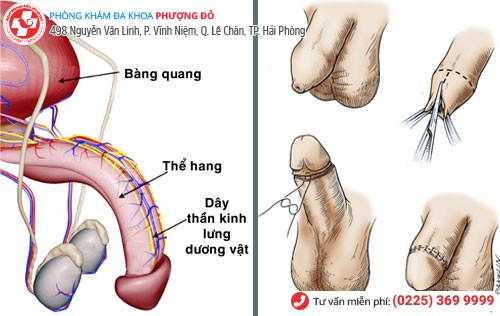 Phương pháp chữa trị trầy xước bao quy đầu Chữa trầy xước bao quy đầu