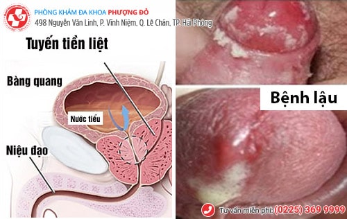 Đái buốt ở nam là bệnh gì? Chữa bằng phương pháp nào hiệu quả? Đái buốt ở nam là bệnh gì? Chữa bằng phương pháp nào hiệu quả?