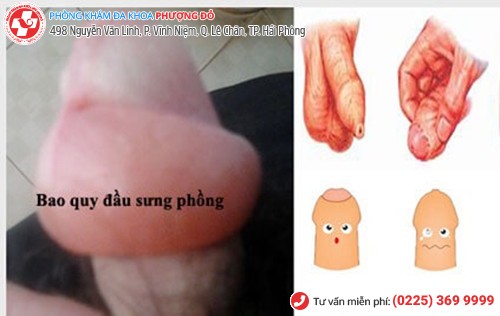 dài hẹp bao quy đầu