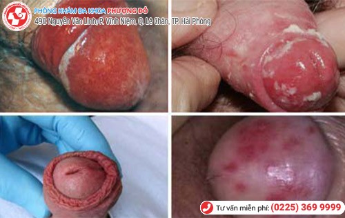 Đau buốt quy đầu do viêm bao quy đầu Đau buốt quy đầu do viêm bao quy đầu