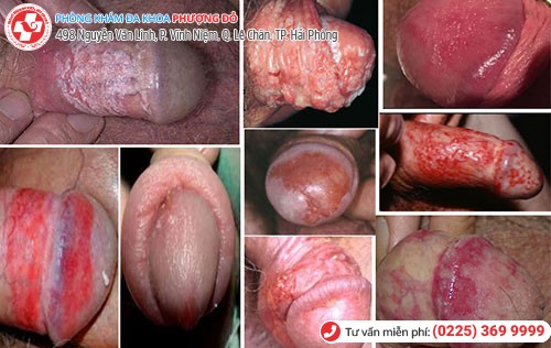 1 số dấu hiệu cơ bản bệnh nam khoa cần đi khám ngay 1 số dấu hiệu cơ bản bệnh nam khoa cần đi khám ngay