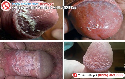 Nấm bao quy đầu – Khốn khổ vì ngứa rát mọi nơi mọi lúc Nấm bao quy đầu – Khốn khổ vì ngứa rát mọi nơi mọi lúc