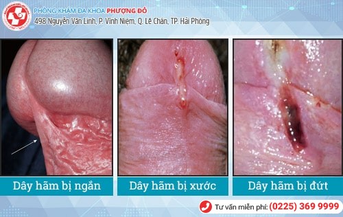 Tổng quan dây hãm bao quy đầu nam giới nên biết Tổng quan dây hãm bao quy đầu nam giới nên biết