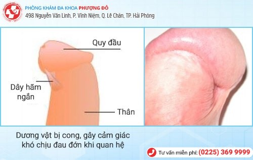 Dây hãm quy đầu bị ngắn có biểu hiện nào? Nguy hiểm không? Dây hãm quy đầu bị ngắn có biểu hiện nào? Nguy hiểm không?
