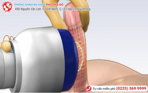 điều trị bệnh liệt dương