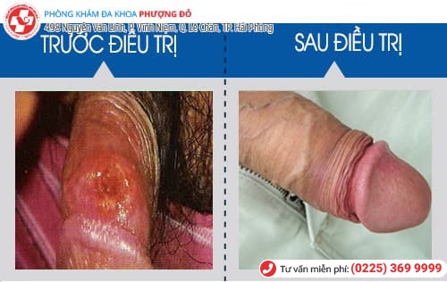 chữa ngứa bao quy đầu