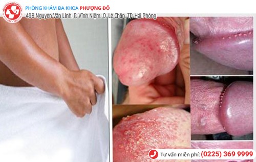 Hình ảnh mẩn đỏ dương vật do viêm bao quy đầu Hình ảnh mẩn đỏ dương vật do viêm bao quy đầu