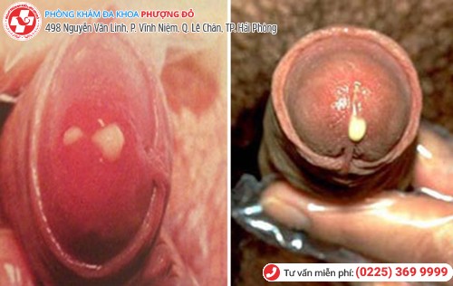 Bệnh lậu khiến dương vật chảy dịch Bệnh lậu khiến dương vật chảy dịch